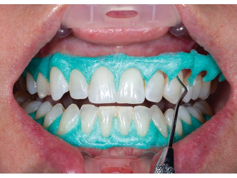 Ultradent - λευκανση - δοντια - OpalDam Green Μεμονωμένες Σύριγγες OpalDam - Ρητινώδες υλικό προστασίας 